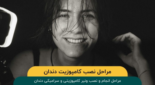 مراحل-نصب-کامپوزیت-دندان